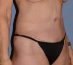 Tummy Tuck