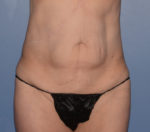 Tummy Tuck