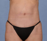 Tummy Tuck