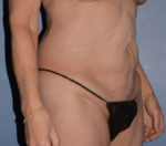 Tummy Tuck