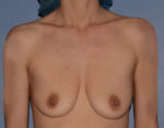 Breast Augmentation Implants