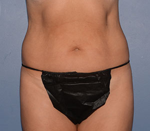 Tummy Tuck