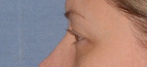 Eyelid Lift