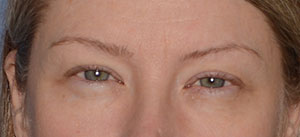 Eyelid Lift