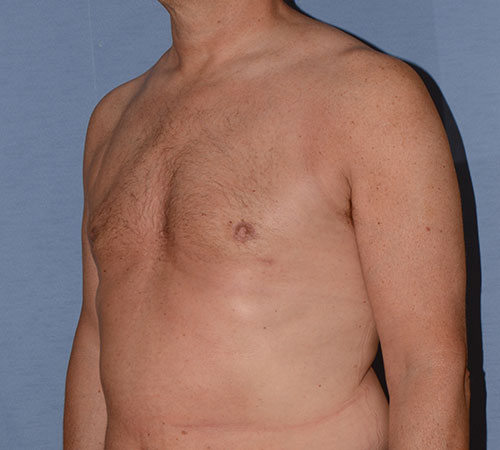 Male Breast Reduction Gynecomastia