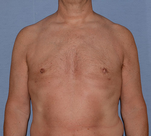 Male Breast Reduction Gynecomastia