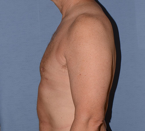 Male Breast Reduction Gynecomastia