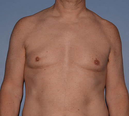 Male Breast Reduction Gynecomastia