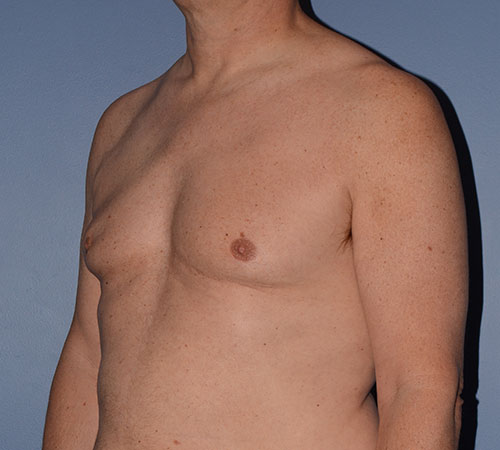 Male Breast Reduction Gynecomastia