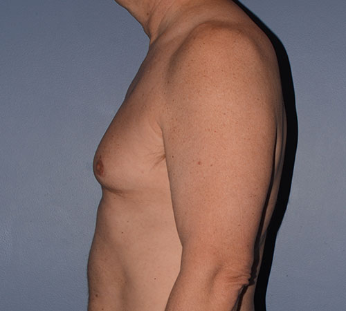 Male Breast Reduction Gynecomastia