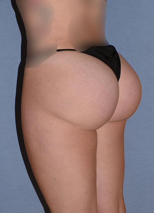 Liposuction