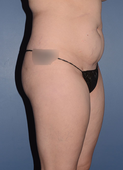 Liposuction