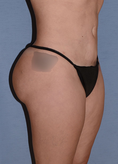 Liposuction