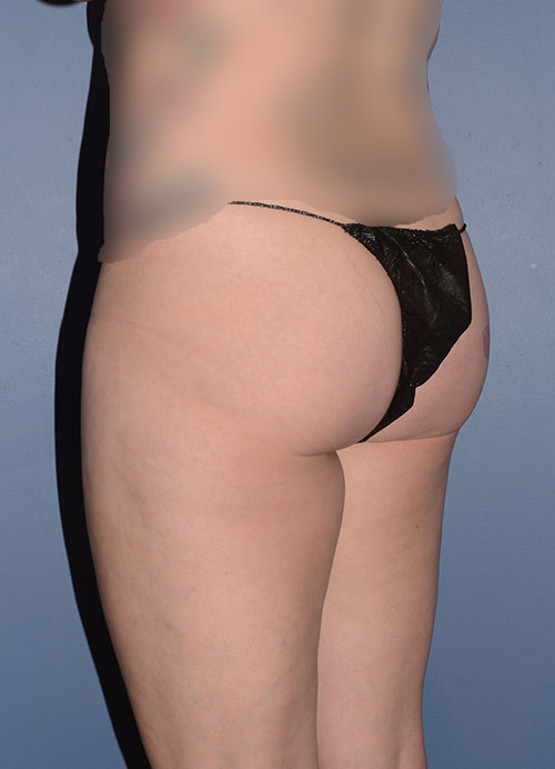 Liposuction