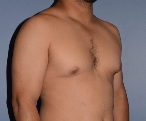 Male Breast Reduction Gynecomastia