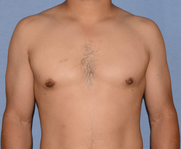 Male Breast Reduction Gynecomastia