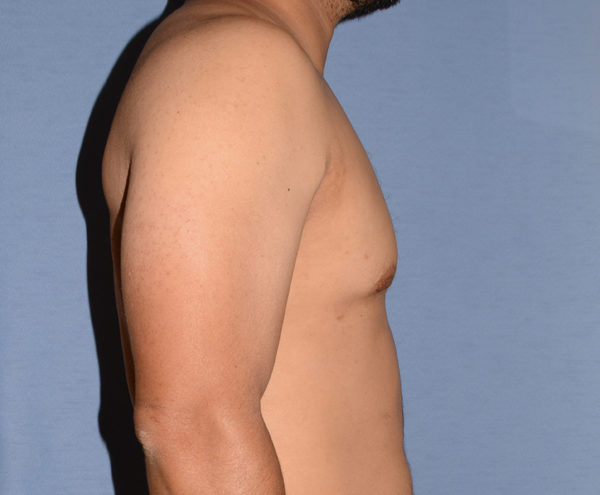 Male Breast Reduction Gynecomastia