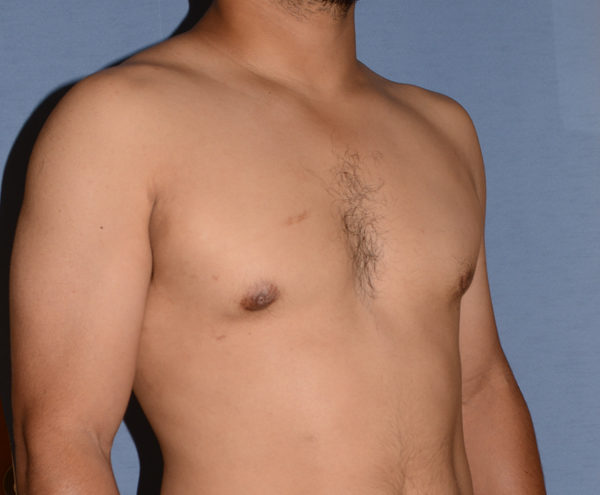 Male Breast Reduction Gynecomastia