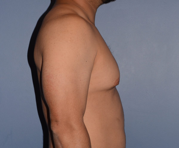 Male Breast Reduction Gynecomastia