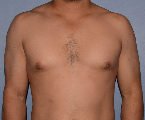 Male Breast Reduction Gynecomastia