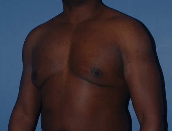 Male Breast Reduction Gynecomastia