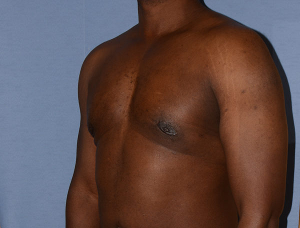 Male Breast Reduction Gynecomastia