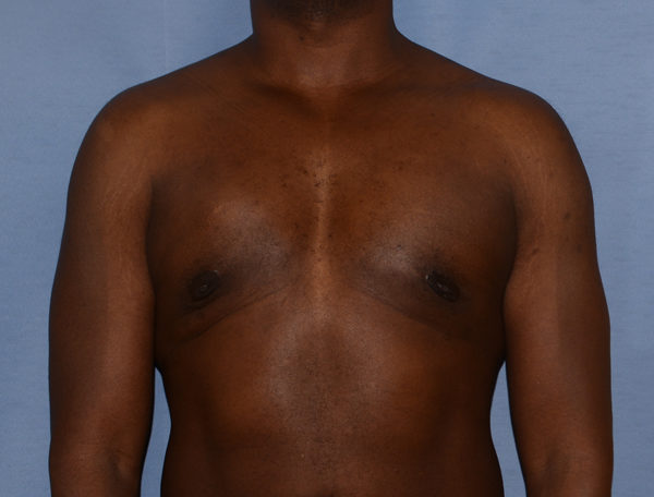 Male Breast Reduction Gynecomastia