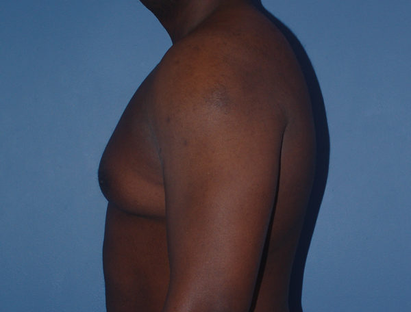 Male Breast Reduction Gynecomastia