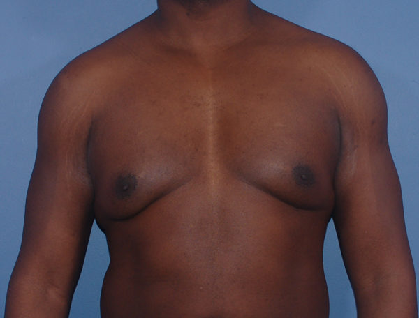 Male Breast Reduction Gynecomastia