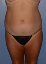 Liposuction