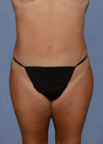 Liposuction