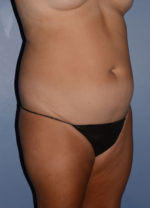 Liposuction