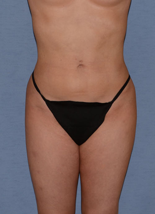 Liposuction