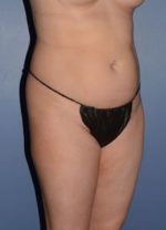 Liposuction