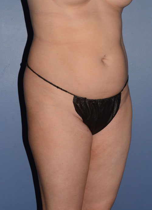 Liposuction