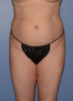 Liposuction