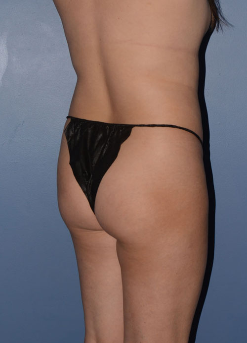 Liposuction