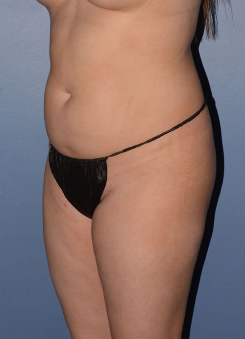 Liposuction