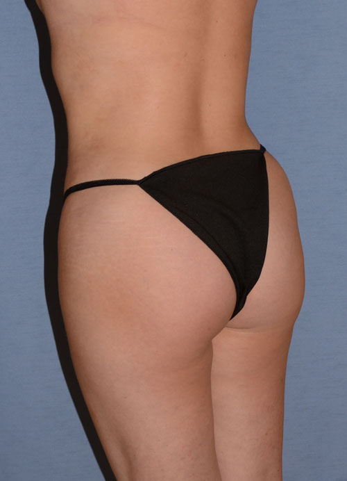 Liposuction