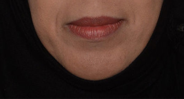 Chin Implant