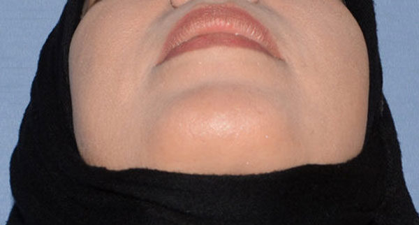 Chin Implant