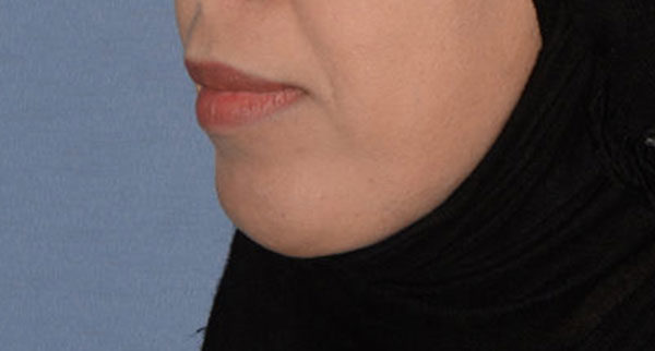 Chin Implant