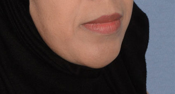 Chin Implant