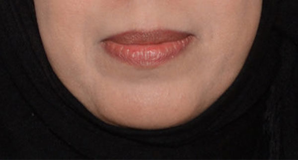 Chin Implant