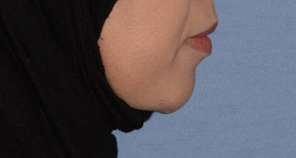 Chin Implant