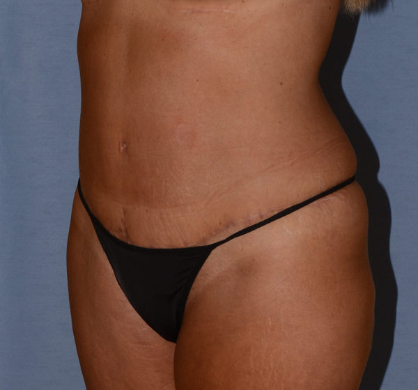 Tummy Tuck