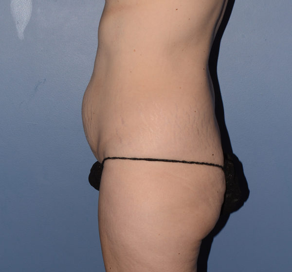 Tummy Tuck