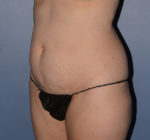 Tummy Tuck