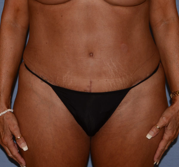 Tummy Tuck