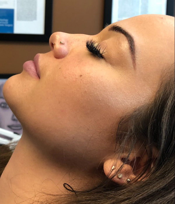 Non-Surgical Rhinoplasty